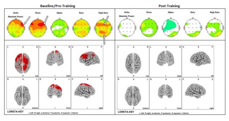 ADHD Before & After Neurofeedback Training chart.